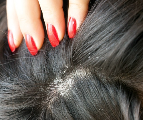 Le psoriasis du cuir chevelu et la perte de cheveux 1