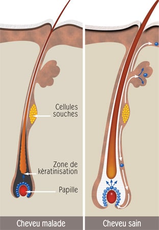 Cheveu-malade-cheveu-sain