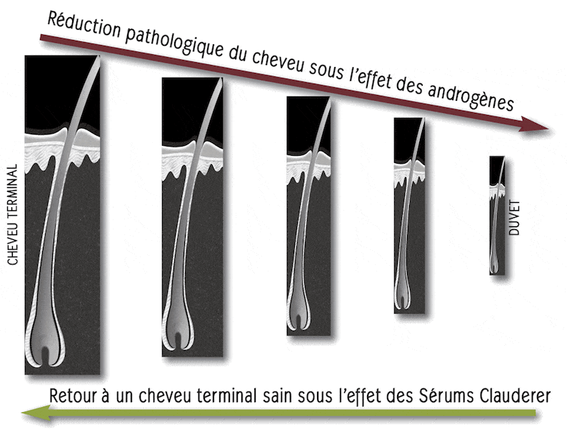 Action des androgènes sur le cheveu