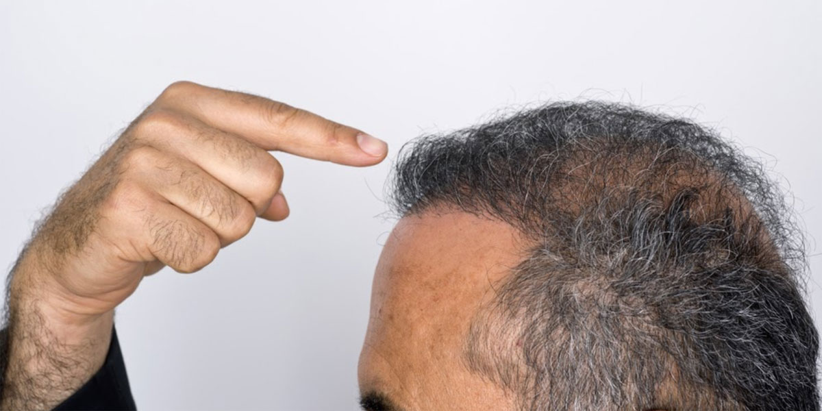 Alopécie / Perte De Cheveux : Les Causes ➤ Centre Clauderer